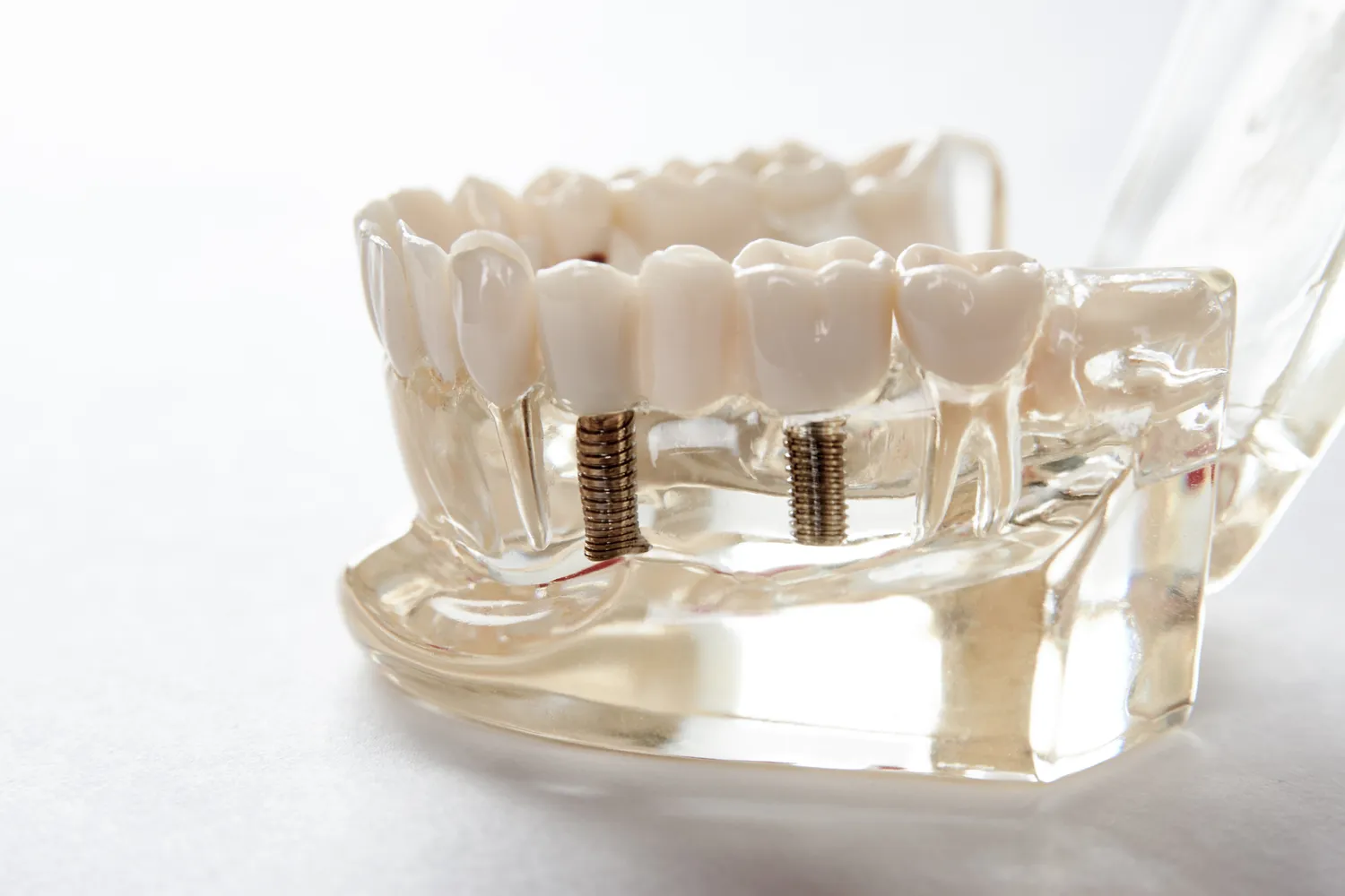 Dentysta Szczecin implanty