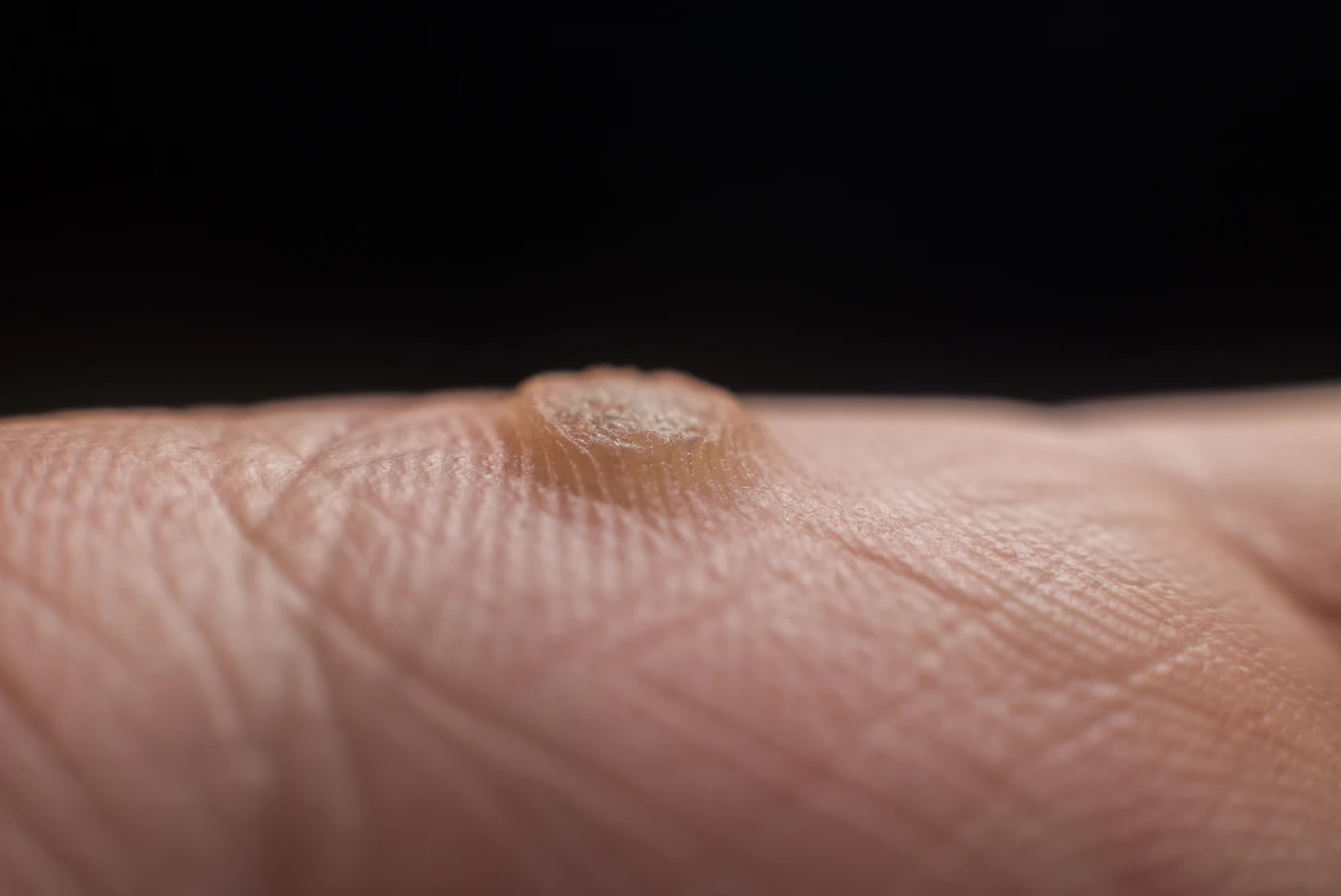 Jak zlikwidować kurzajki?