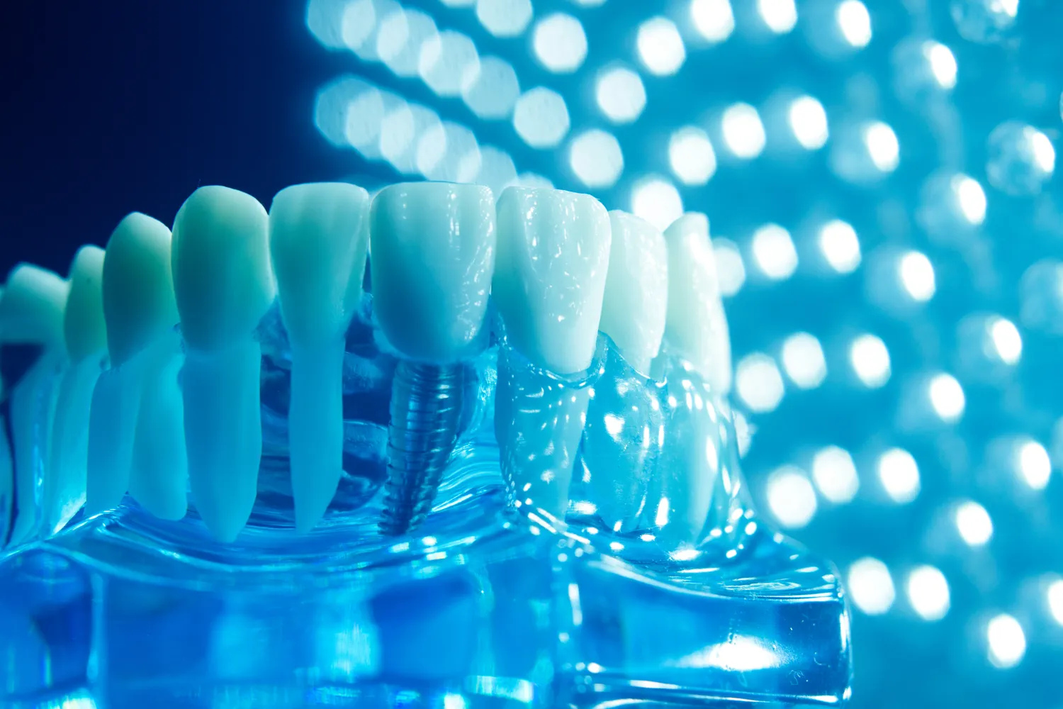 Kiedy leczenie kanałowe?