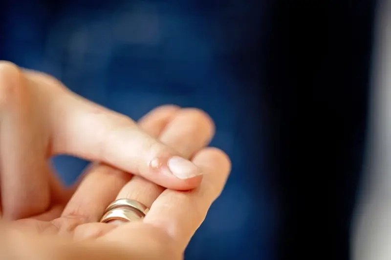 Od czego są kurzajki?